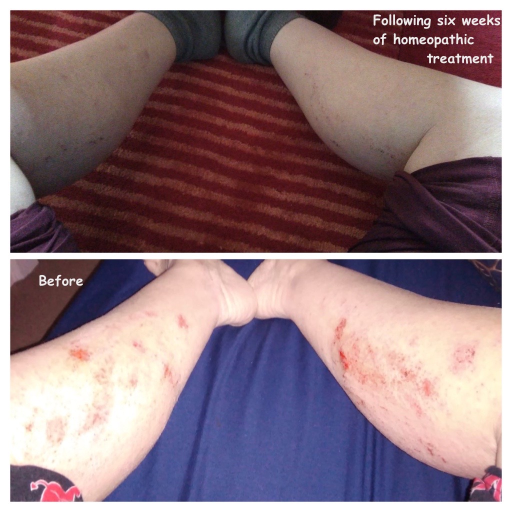 Topical Steroid Withdrawal